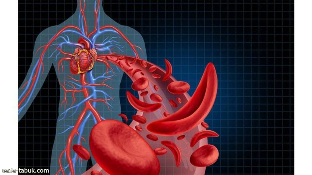 "سعود الطبية" تنصح المصابين بالأنيميا المنجلية بشرب كميات كافية من الماء وتجنُّب الضغوط اليومية