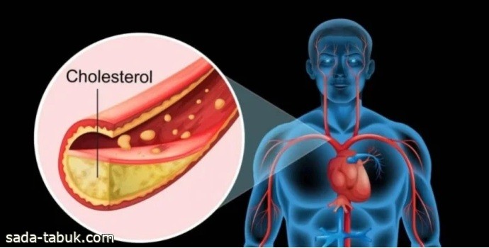 أطعمة ترفع نسبة الكوليسترول الضار في الدم وتزيد خطر الإصابة بالسكتة الدماغية والنوبة القلبية