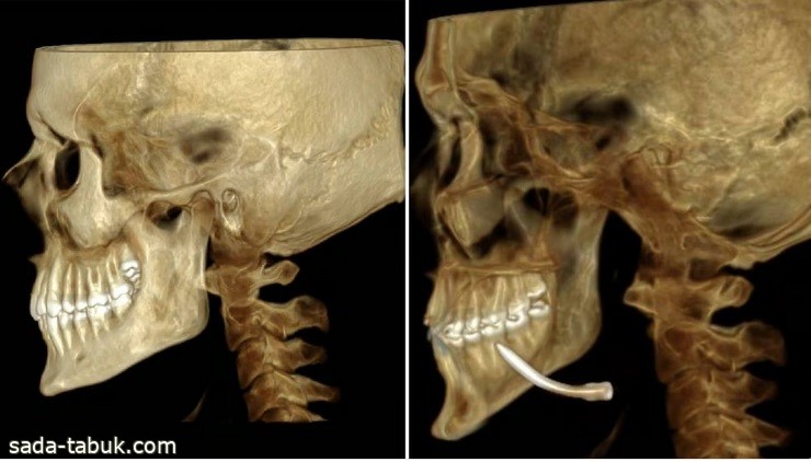 إنجاز طبي.. "سعود الطبية" تستخرج مسمارًا معدنيًا من قاع فم مريض