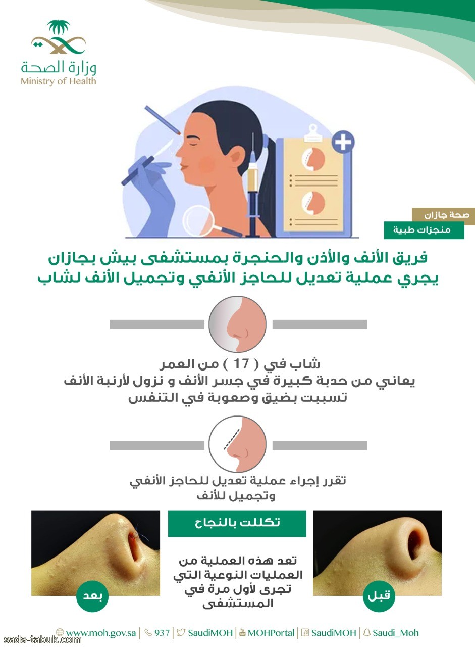 تعديل للحاجز الأنفي وتجميل الأنف لمريض في جازان