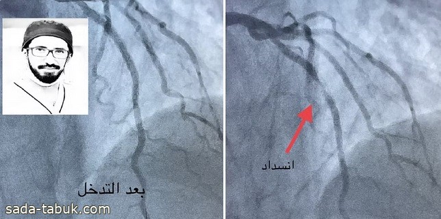 جلطة بعد 4 أشهر.. استشاري: لا تتوقف عن المسيلات بعد إجراء توسيع الشرايين