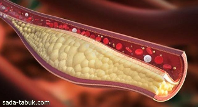 تراجع نسبة الإصابة بالكوليسترول في السعودية إلى 35%
