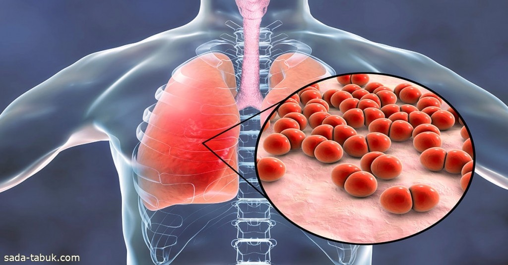ماهي الأمور التي تساعد على الوقاية من الالتهاب الرئوي؟ .. مدينة الملك سعود الطبية توضح!
