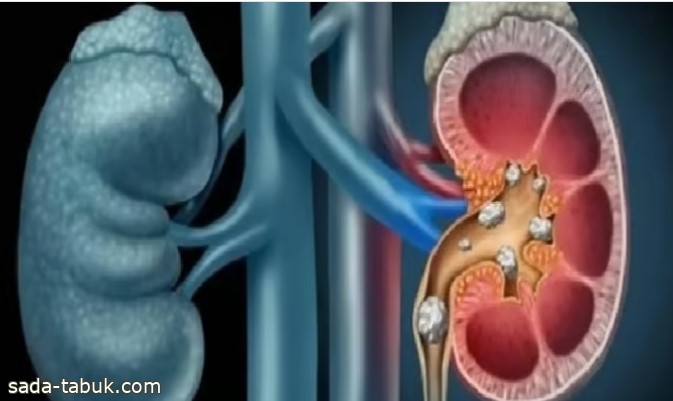 استشاري: 4 نصائح لتجنب الإصابة بحصوات الكلى